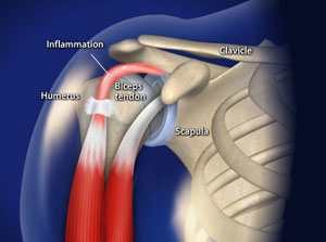 omaha biceps tendinitis