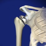 South Sioux City shoulder replacement