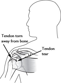 rotator cuff tear